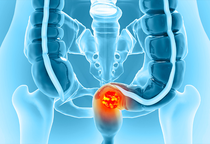 Cancer colon
