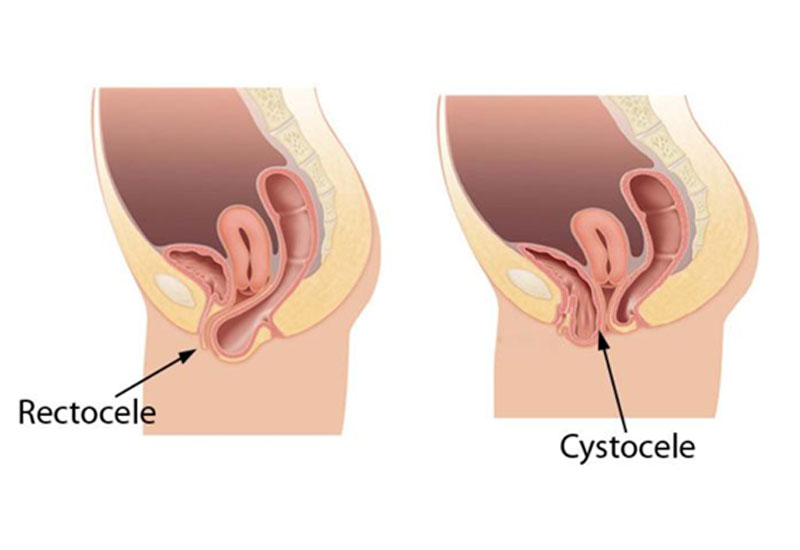Surgery of the perineum / pelvic floor