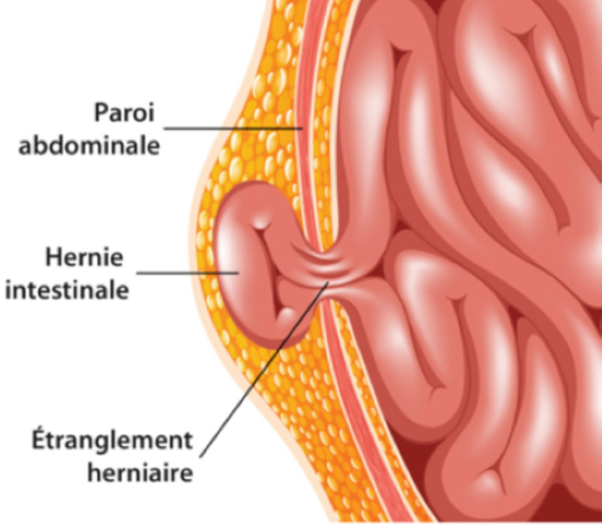 hernie