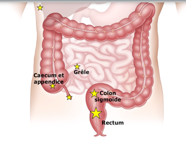 endometriose